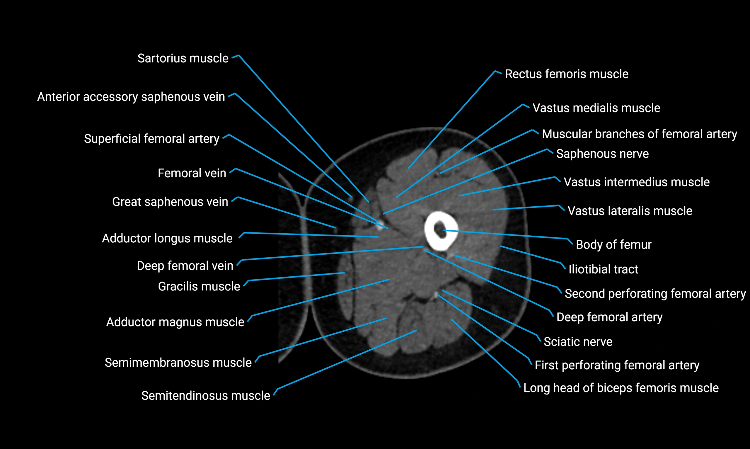 CT lower limb axial cross sectional anatomy labelled image 44 (2).webp